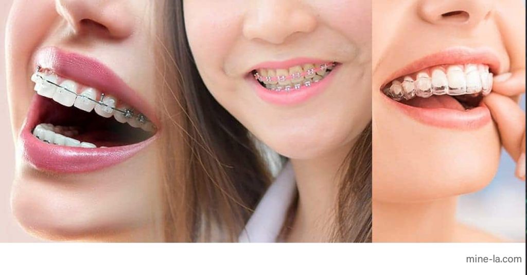 ทันตกรรมจัดฟัน เป็นสาขาทันตกรรมพิเศษที่เน้นการป้องกันและแก้ไขฟันและกรามที่ผิดตำแหน่ง ในขณะที่ทันตแพทย์ทั่วไปมุ่งเน้นไปที่ฟันผุ