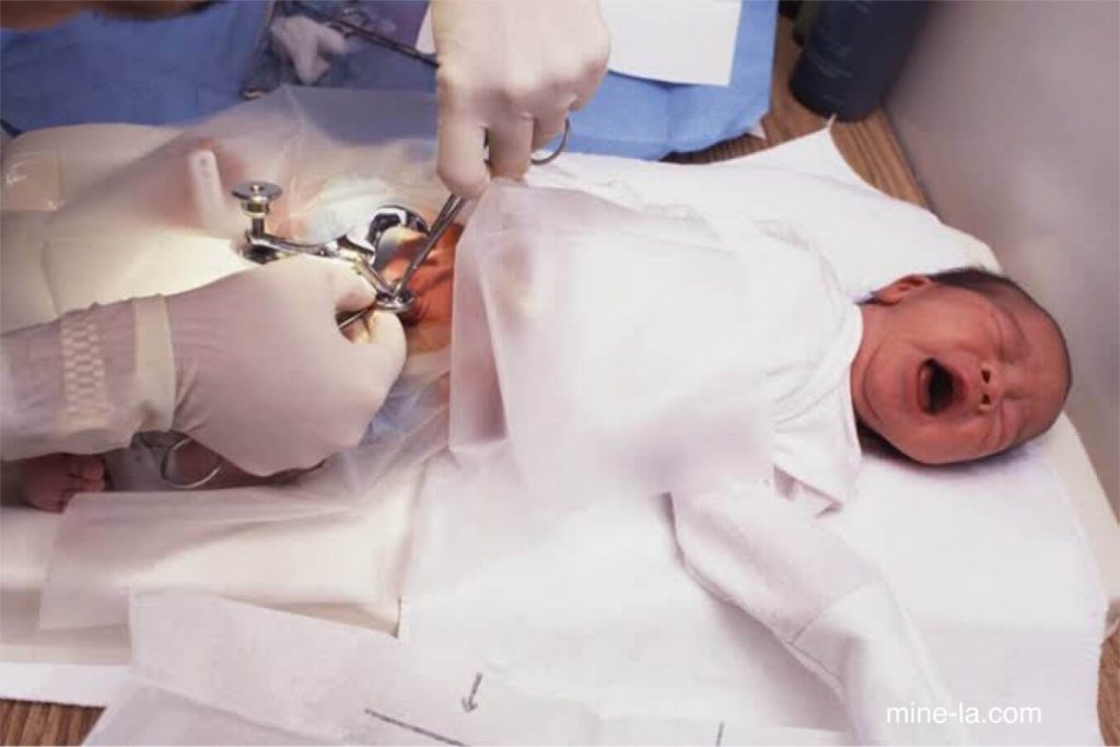 การขลิบ เป็นการผ่าตัดเอาผิวหนังที่หุ้มปลายองคชาตออก กระบวนการนี้ค่อนข้างธรรมดาสำหรับเด็กชายแรกเกิดในบางส่วนของโลก รวมถึงส