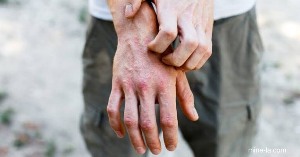 อาการคันมือและเท้า อาจเกิดจากผิวแห้งและสภาวะต่างๆ รวมถึงกลาก อาการแพ้ โรคสะเก็ดเงิน เบาหวาน และหิด สาเหตุบางประการอาจ