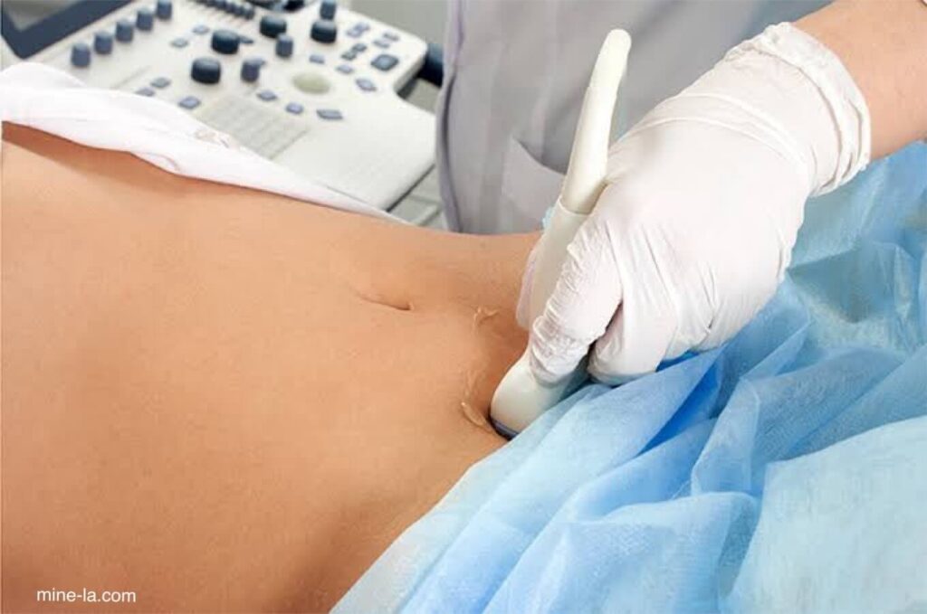 อัลตราซาวนด์ช่องท้อง เป็นการทดสอบภาพทางการแพทย์ที่ใช้คลื่นเสียงเพื่อดูภายในบริเวณท้อง เป็นการตรวจคัดกรองที่แนะนำสำหรับหลอด
