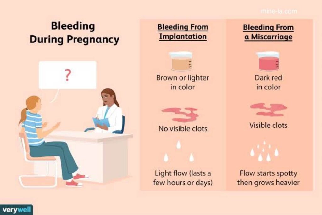 Implantation Bleeding เป็นสัญญาณเริ่มแรกของการตั้งครรภ์ที่เกิดขึ้นเมื่อไข่ที่ปฏิสนธิ ฝังเข้าไปในผนังมดลูกของบุคคล อาจทำให้เลือดออกเล็ก