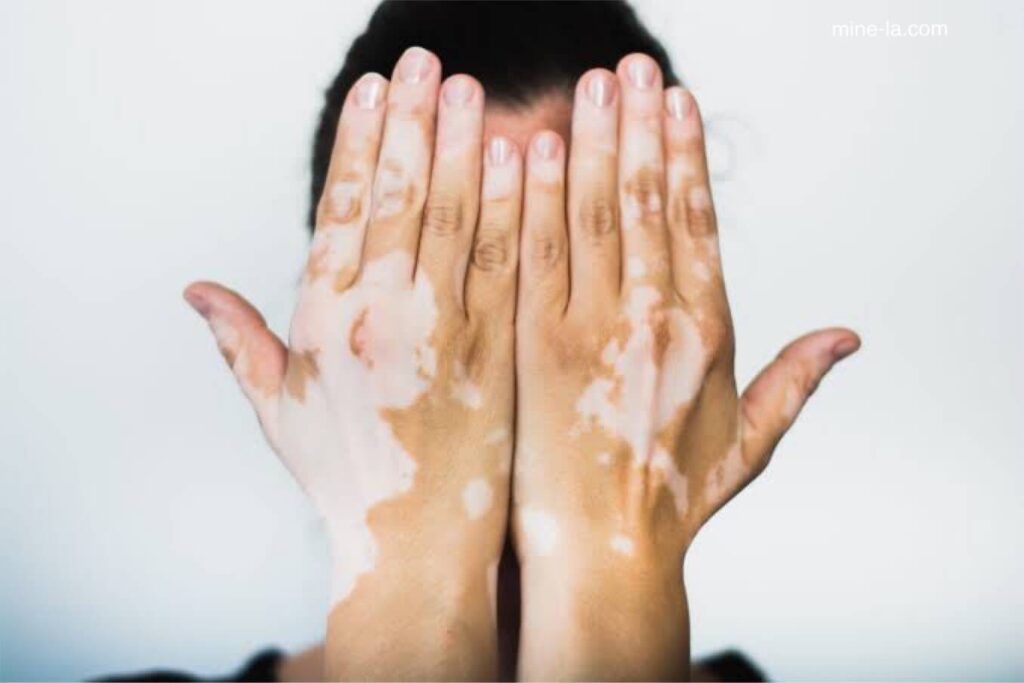 โรคด่างขาว หรือ Vitiligo ทำให้ผิวของคุณสูญเสียสีหรือสีผิวคล้ำ บริเวณที่เป็นสีขาวหรือสีอ่อนที่เรียกว่ามาคูลหรือรอยปื้นปรากฏบนผิวของคุ