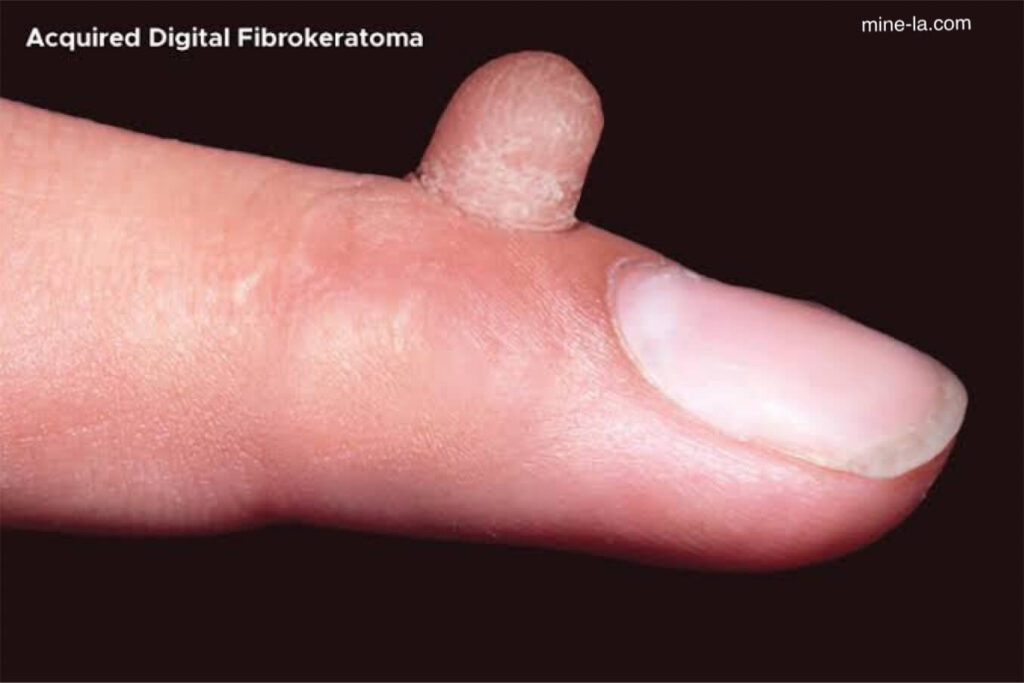 Fibrokeratoma เป็นเนื้องอกชนิดไม่ร้ายแรงที่มักพบที่นิ้วหรือนิ้วมือและนิ้วเท้า เรียกอีกอย่างว่า acral fibrokeratoma ซึ่งเป็นภาวะที่พบได้ไ