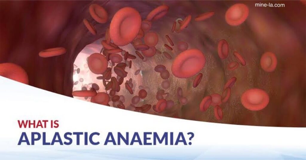 โรคโลหิตจางชนิดอะพลาสติก หรือ Aplastic anemia คือภาวะที่ร่างกายผลิตเม็ดเลือดใหม่ได้ไม่เพียงพอ ส่งผลให้ร่างกายอ่อนล้าและเสี่