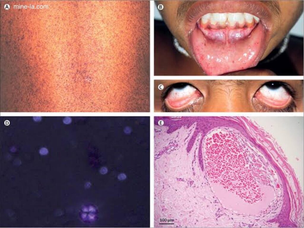 Fabry Disease เป็นโรคทางพันธุกรรมที่พบได้น้อยซึ่งเกิดจากการสะสมของเอนไซม์ในไลโซโซมในร่างกายไม่เพียงพอ เอนไซม์เหล่านี้จะสะส