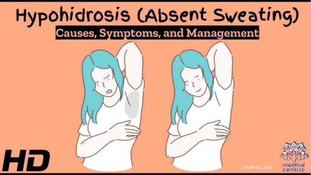 Hypohidrosis หรือที่เรียกกันว่าภาวะเหงื่อออกน้อย คือภาวะที่ร่างกายไม่สามารถระบายความร้อนด้วยการขับเหงื่อได้ โดย ปกติแล้ว เมื่อคุณรู้สึกร้อ