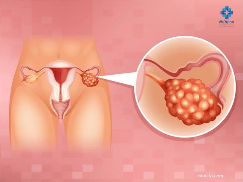Polycystic ovary syndrome เป็นปัญหาของฮอร์โมนที่เกิดขึ้นในช่วงวัยเจริญพันธุ์ หากคุณเป็นโรค PCOSคุณอาจมีประจำเดือนไม่บ่อยนัก หรืออาจ