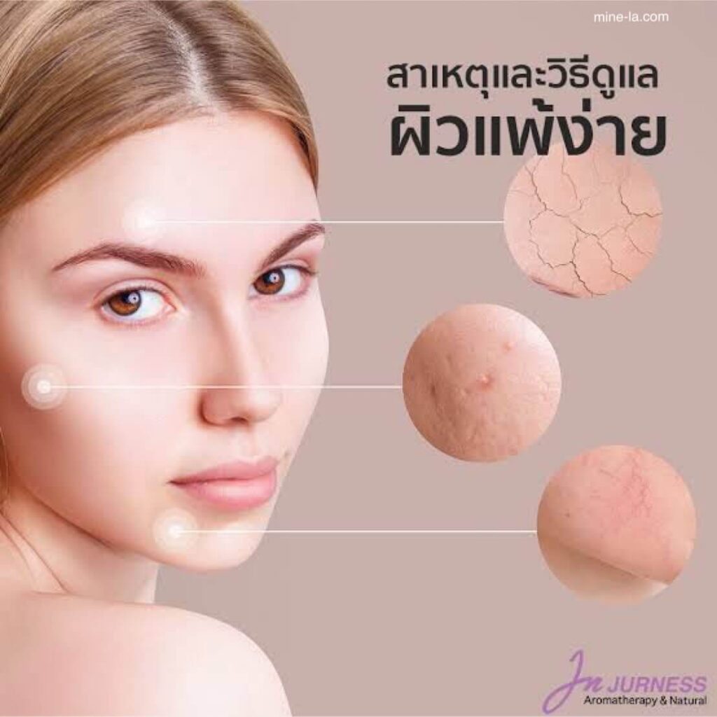 การดูแลผิวแพ้ง่าย ผิวที่บอบบางจะเกิดการระคายเคืองได้ง่ายจากสิ่งกระตุ้นที่โดยปกติแล้วจะไม่ก่อให้เกิดปฏิกิริยาที่ไม่พึงประสงค์ ผิวแพ้